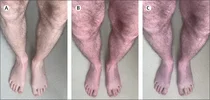 acrocyanosis legs purple stqanidng gr1_lrg.webp