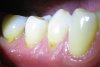 receding-gums-periodontitis.jpg